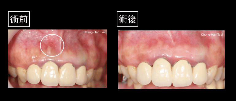 日初牙醫診所 根尖手術